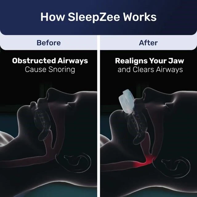 Jeremytis Anti Snoring Device image